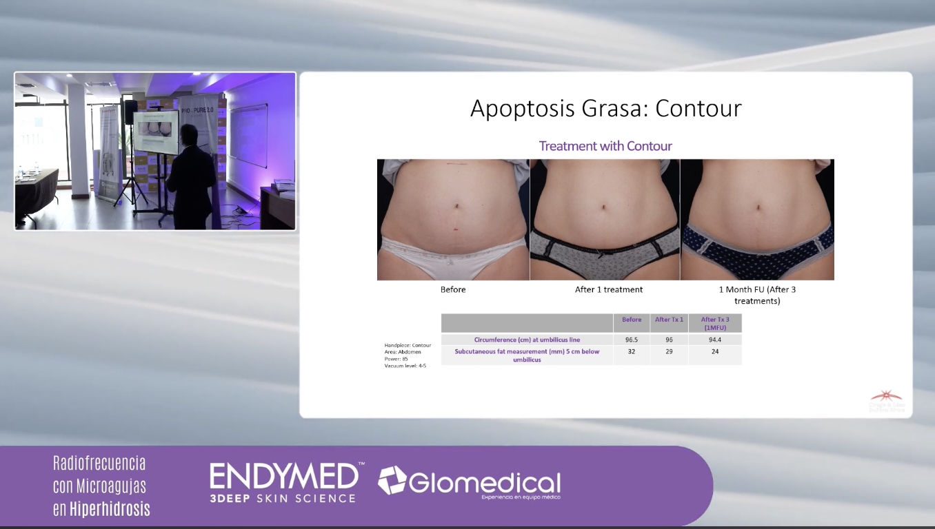 Radiofrequency Workshop — Pro Pure 2.0 by Endymed for Glomedical